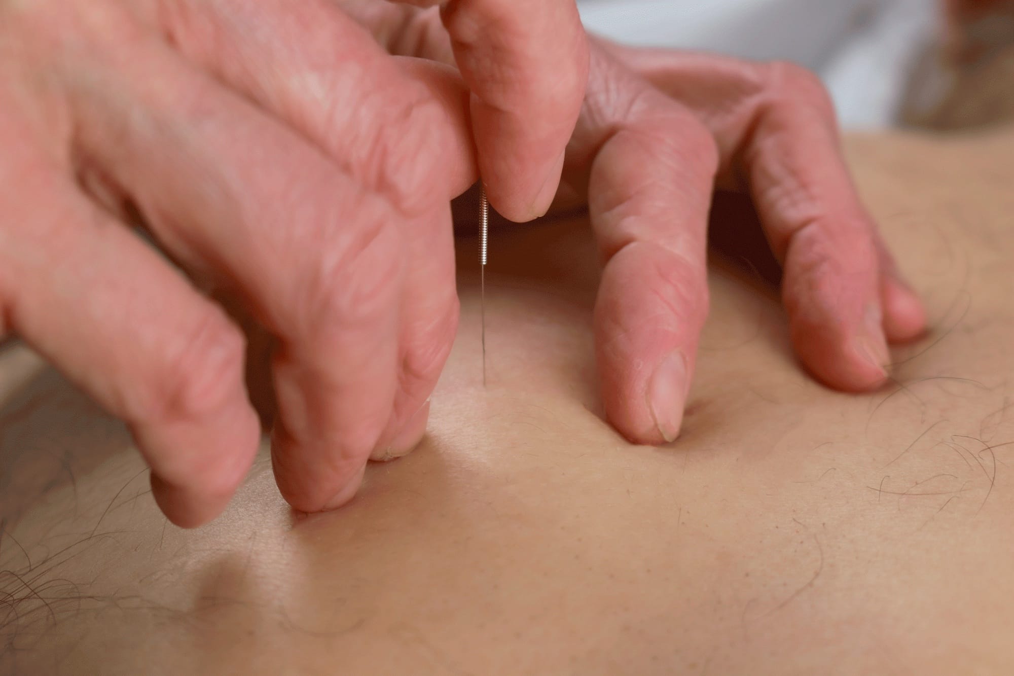 Catherine Stone Acupuncture and Massage Needling 2